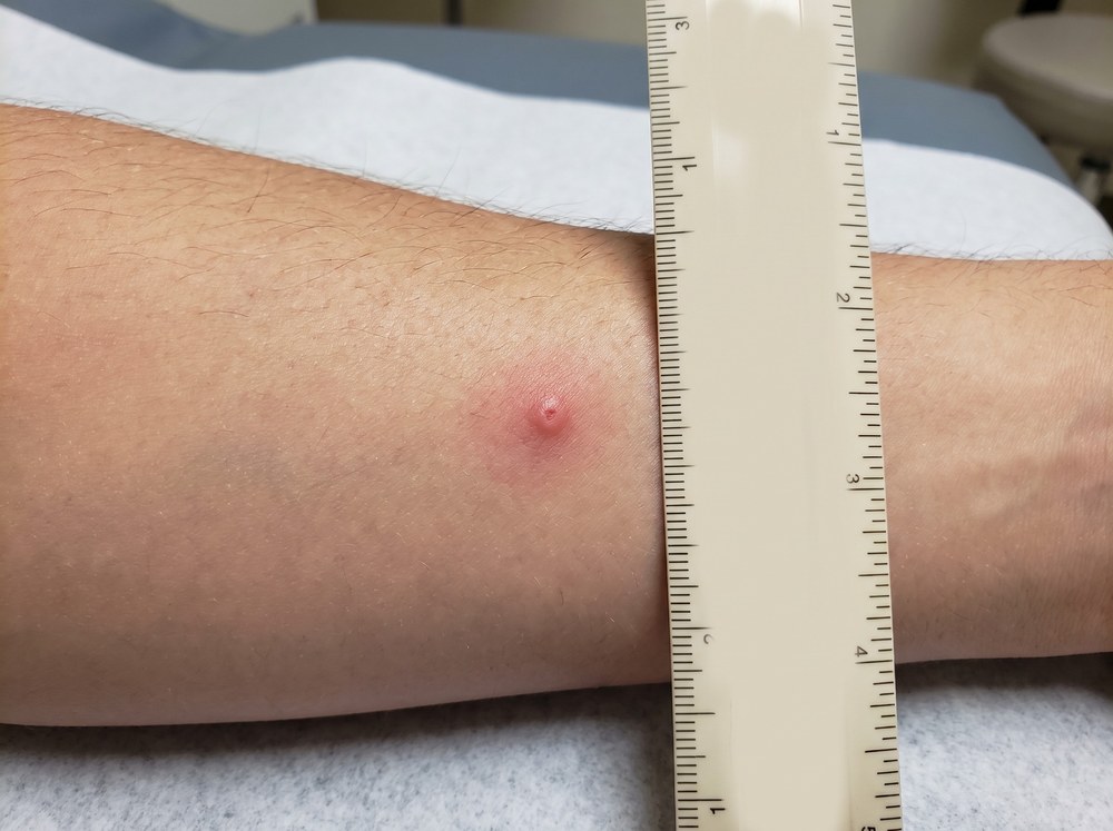 Close-up of a minor pink pinch mark on a finger with no swelling, blistering, or puncture pattern after handling a click beetle